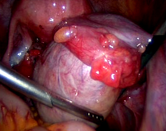 Large Endometrioma