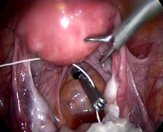 Colpotomy