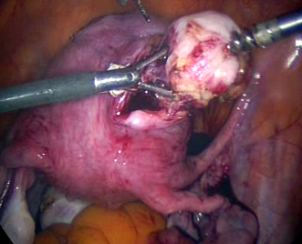 Myomectomy