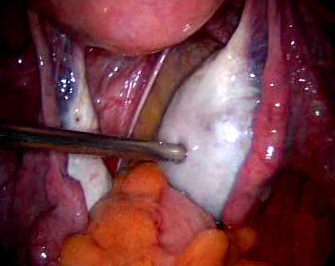 Ovarian Cyst